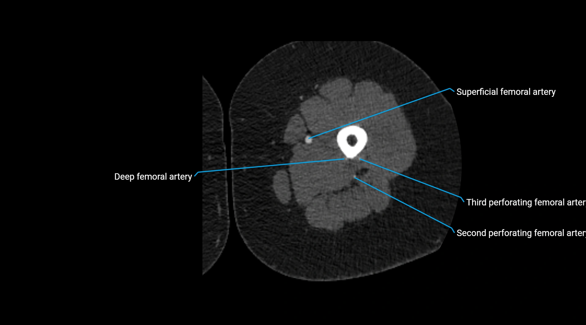 CTA lower limb cross sectional anatomy labelled image _121.webp